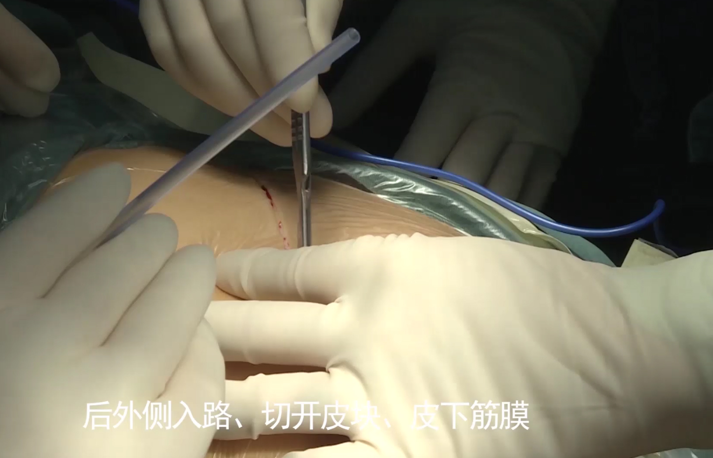 2019力达康瓦格纳柄操作视频-郝鹏教授