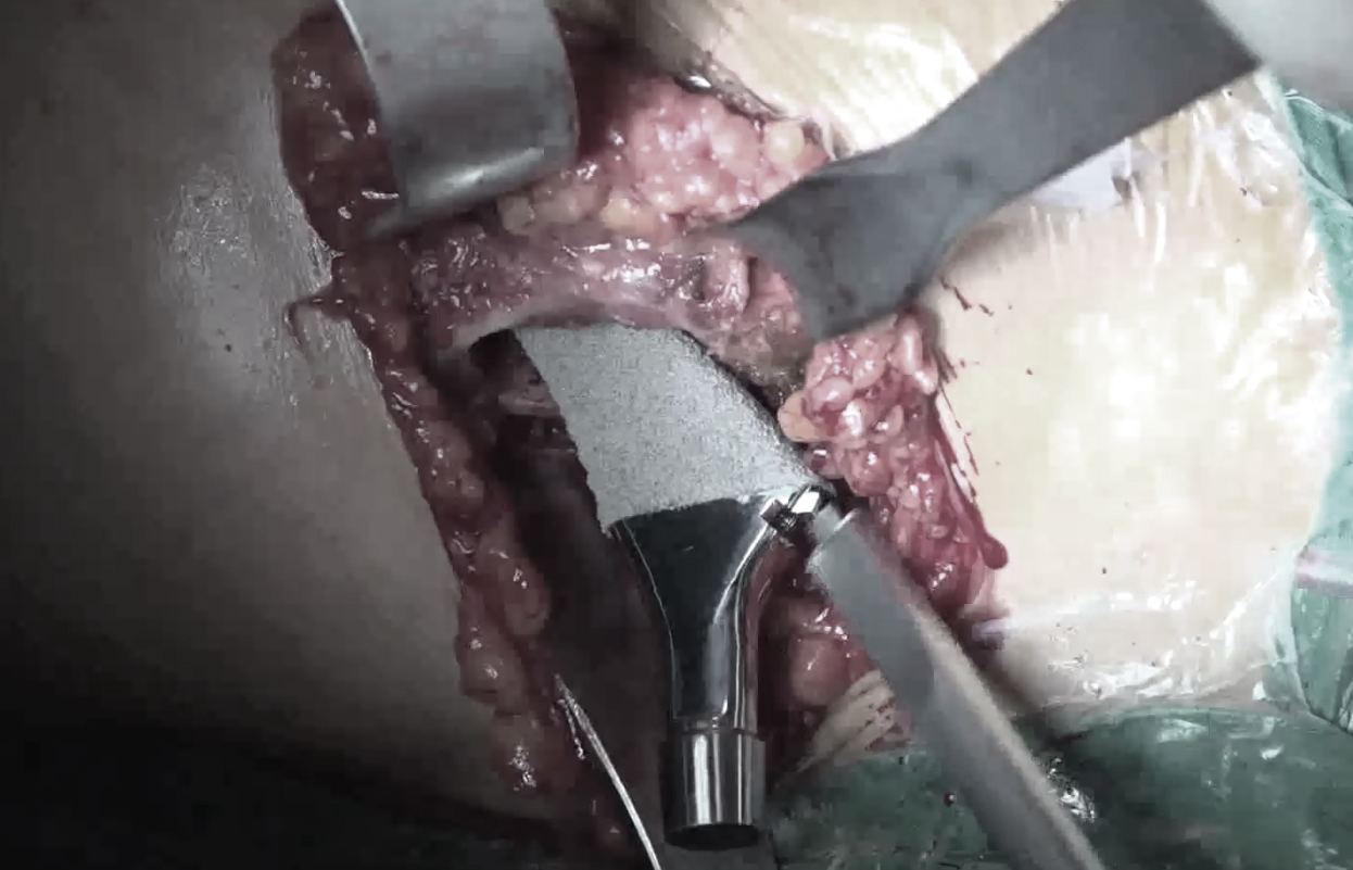 尚希福教授前路入手术视频