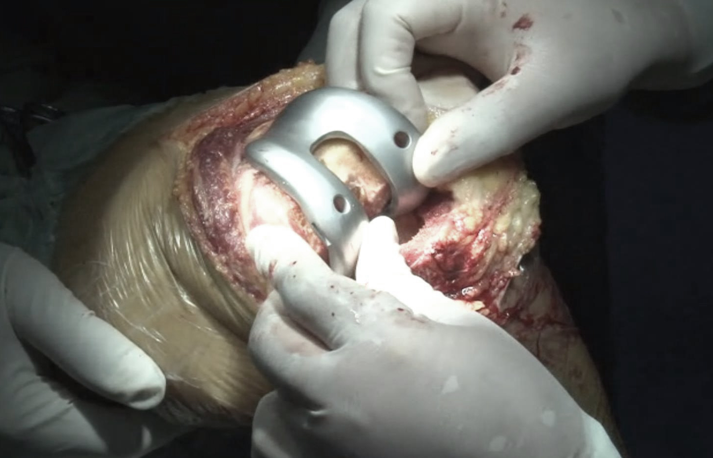 力达康X4膝关节孙永强版