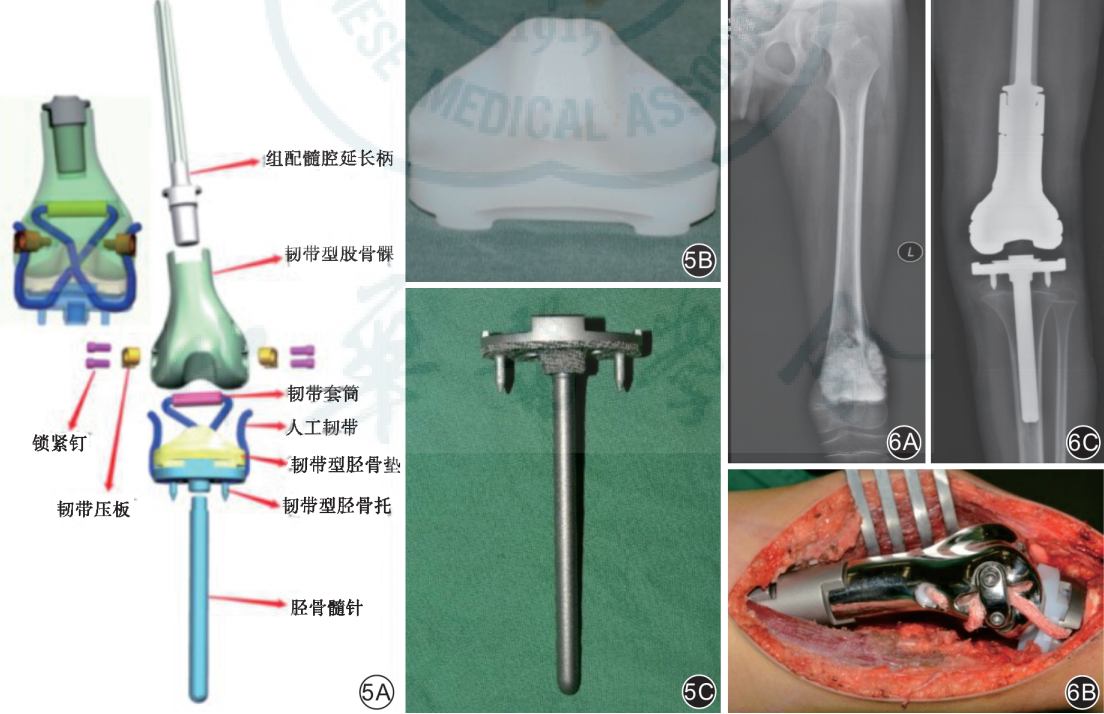 肿瘤型人工关节假体的发展现状及优化策略