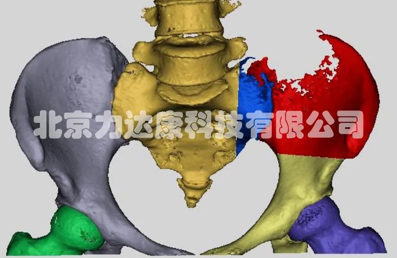 【肿瘤方案合集】力达康定制假体解决骨盆肿瘤的经典设计合集